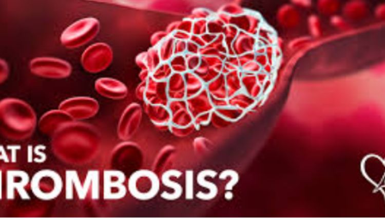 Thrombosis