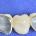 Porcelain Crowns