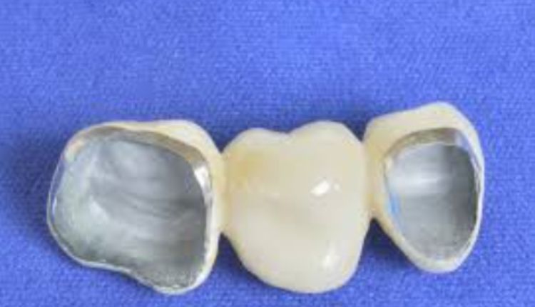 Porcelain Crowns